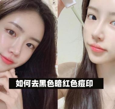 如何去暗红色黑色痘印？护肤达人介绍真正有效去痘印效果好的产品